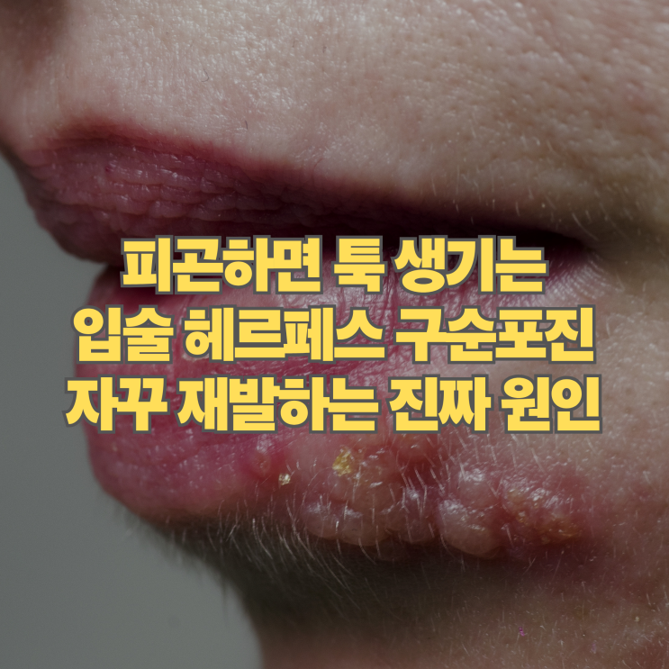  피곤하면 툭, 지긋지긋한 입술 헤르페스 자꾸 재발하는 진짜 원인
