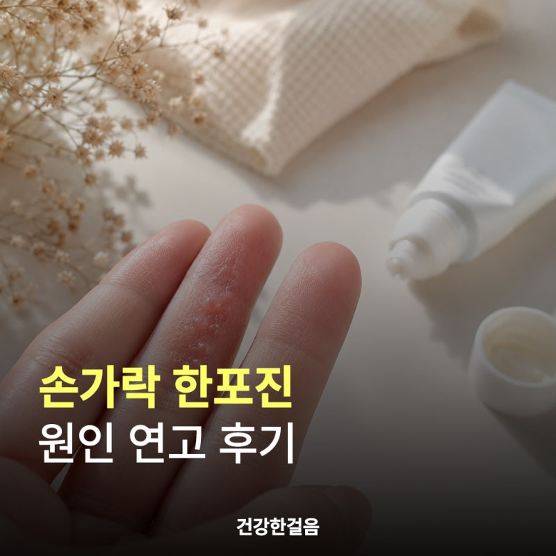 손가락 한포진 원인 연고 후기