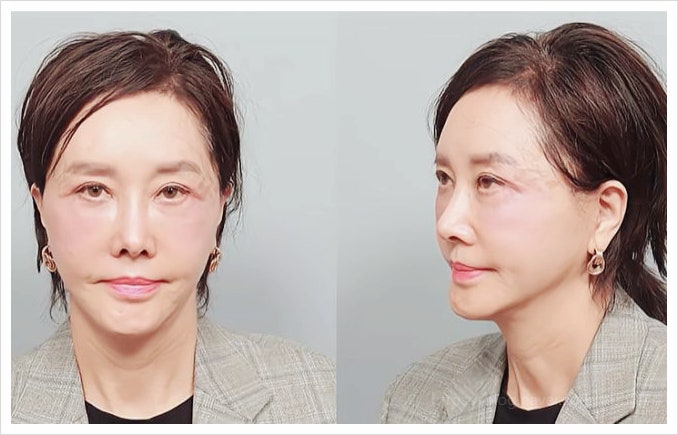  62세 배우 유혜리 안면거상 성형 후 몰라보게 달라진 충격적인 비주얼