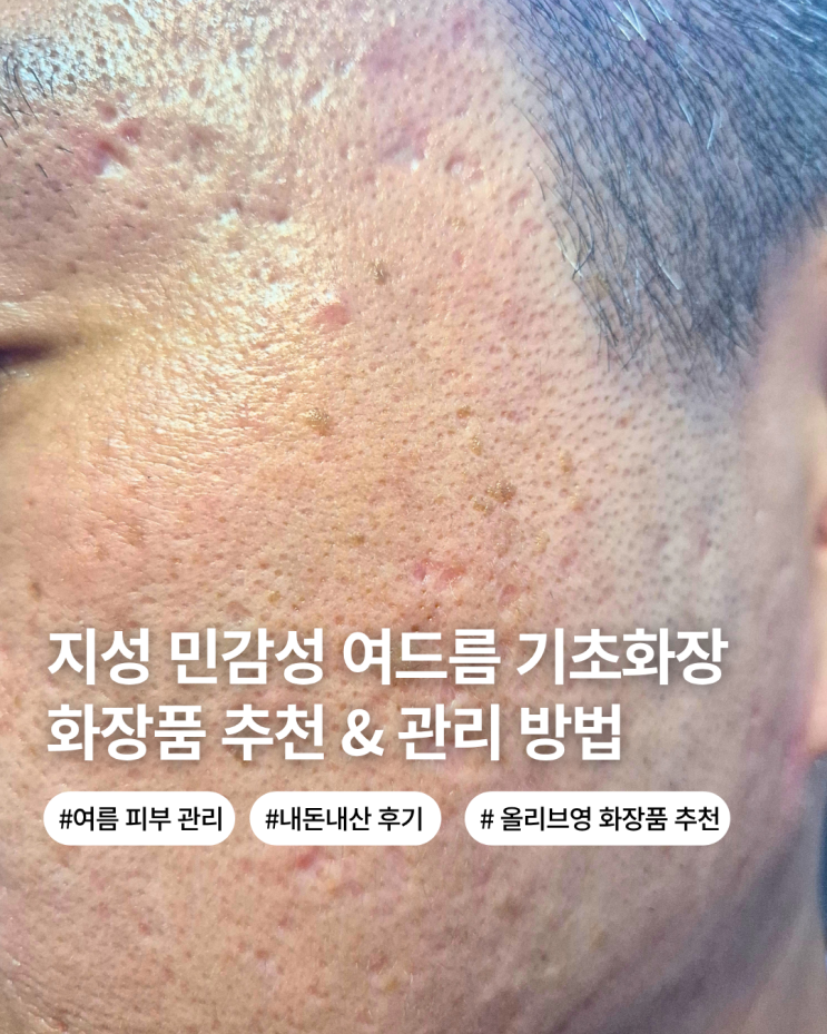  지성 민감성 수부지 여드름 피부 여름철 트러블 없는 저자극 기초 화장품 기초관리법 추천