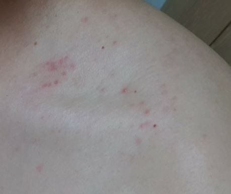 어깨 대상포진 통증, 수포, 치료, 원인, 증상