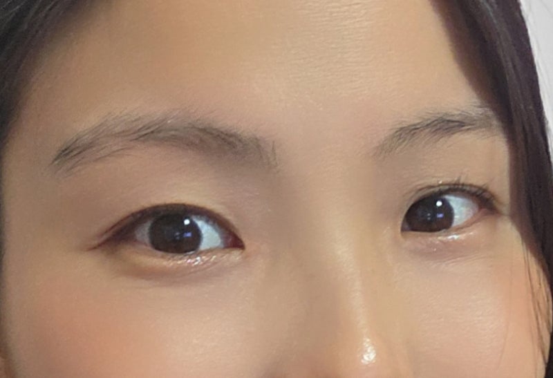 눈두덩이 지방이식 6개월 경과 후기