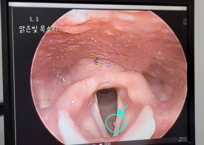 성대결절!!!! 발성을 바꿔야 재발하지 않아요!!