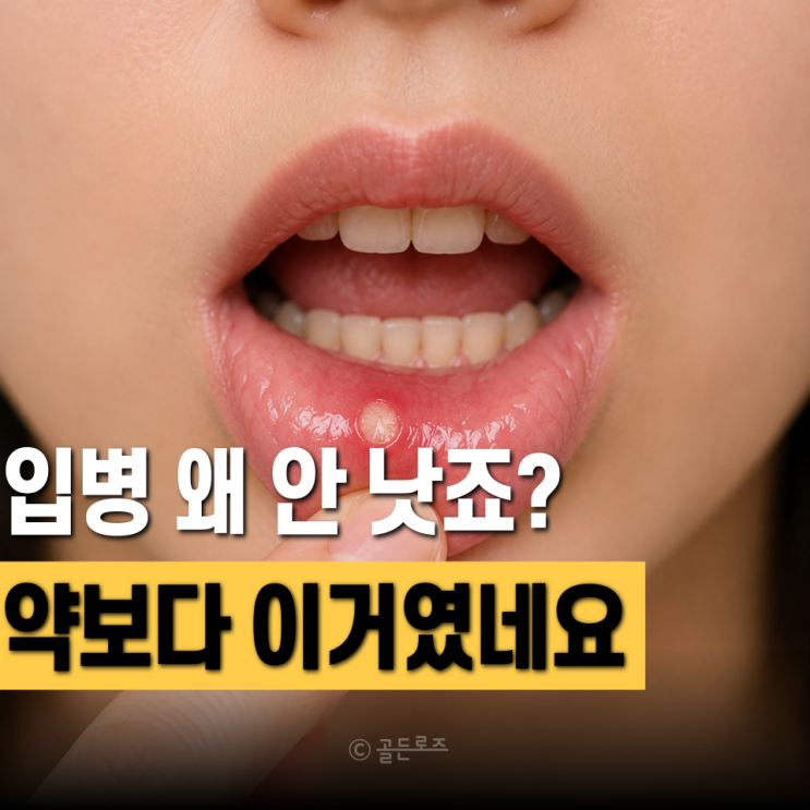  구내염 빨리 낫는법? 하루만에 통증 줄인 사람들 약보다 먼저 한 "이것"