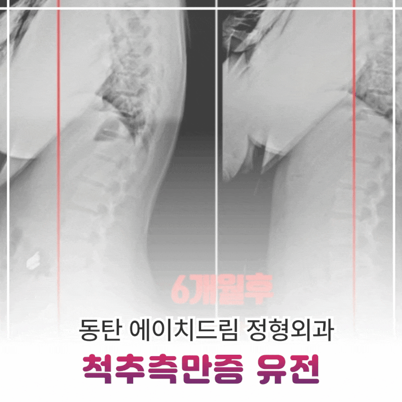 척추측만증 유전, 가족력이 있다면 꼭 확인해야 하는 신호들