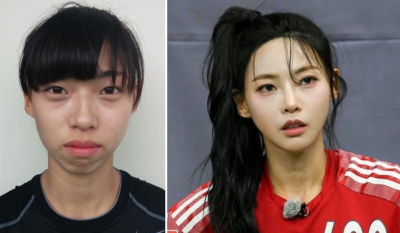 성형 아니라고 억울해하던 김민지, 진짜 이유가 이거였다고요?