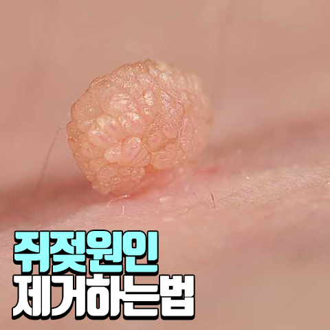 도돌도돌 만져지는 쥐젖 원인, 제거법(식초, 연고)