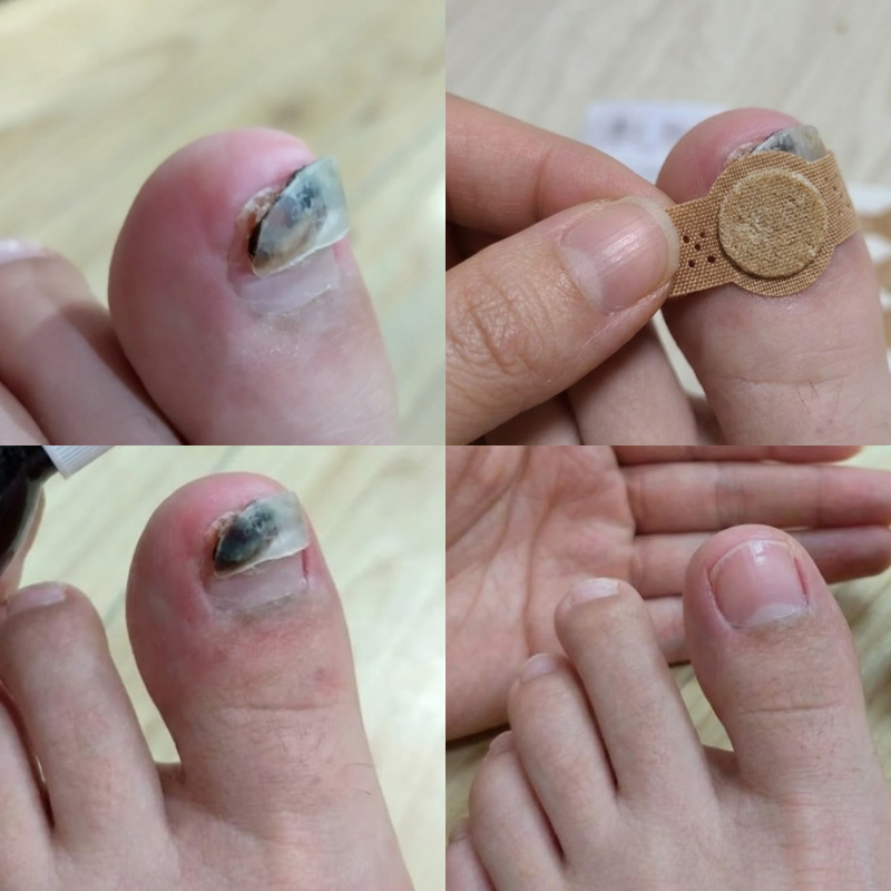 일본 발톱무좀 패치 곰팡이균 뿌리 뽑는 효과 에센스 후기