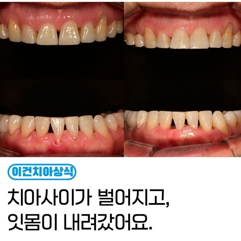 교정후에 잇몸이 내려가고 치아가 벌어졌어요