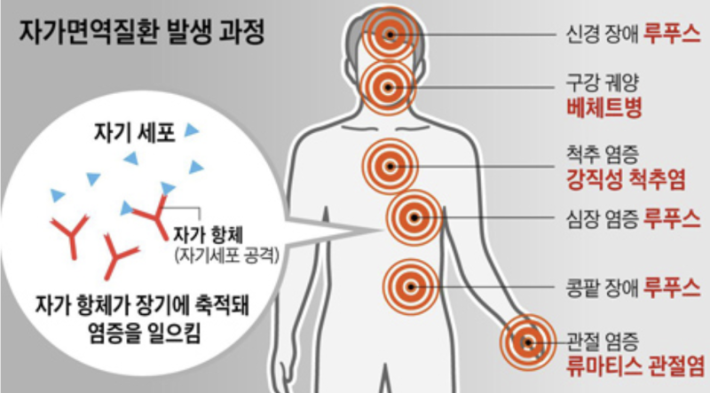 건강정보1탄, 자가면역 질환 '베체트' 환자의 구강관리 (feat.구내염 및 질염 / 산정특례 및 자....