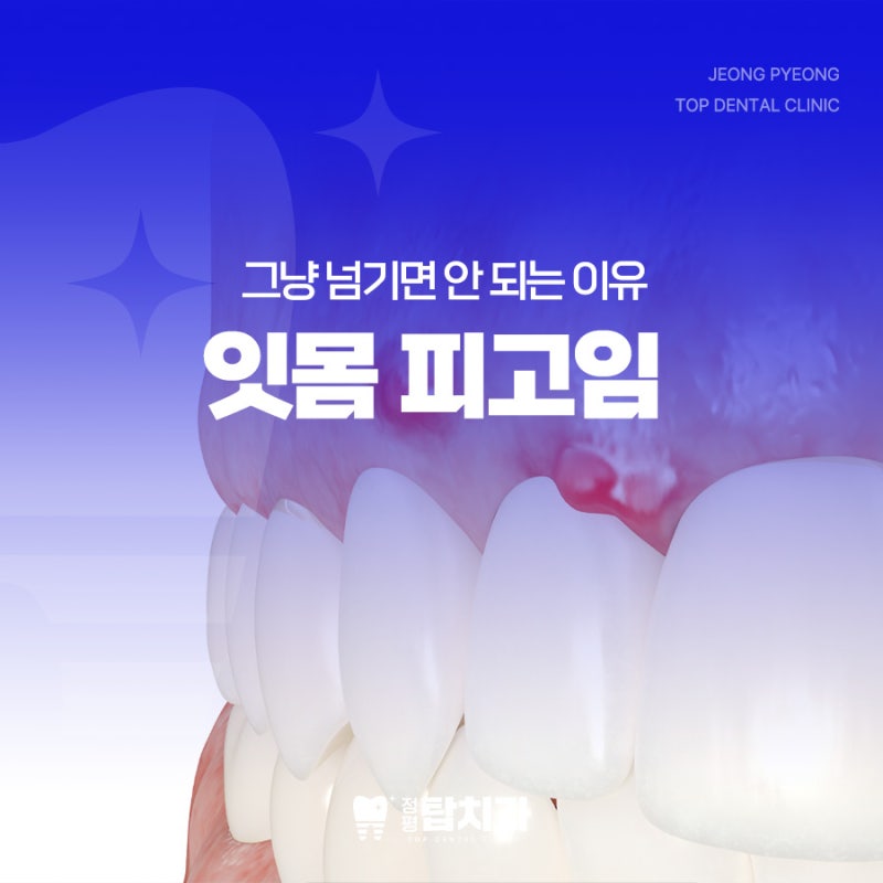 잇몸피고임 원인 증상 : 통증 사라졌다고 방심하시면 안 됩니다