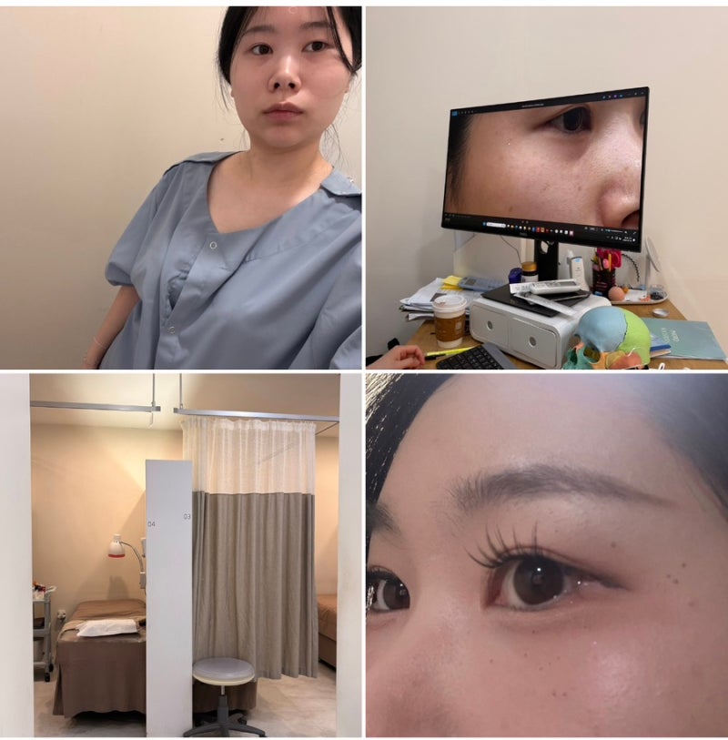 대구편평사마귀제거 쥐젖제거 무제한 성지에서 듀오덤 없이 일주일 만에 꿀피부 된 내돈내....