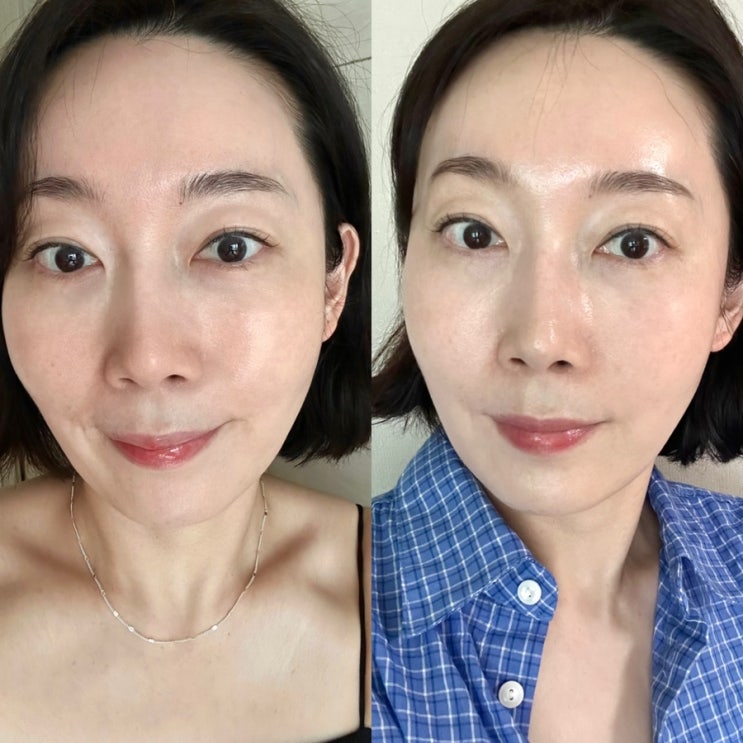  강남역 쥬베룩 볼륨｜40대 마리오네트 입가주름 관리하기
