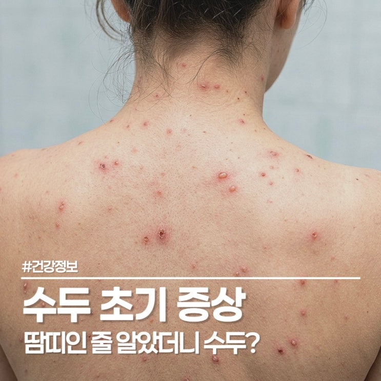  수두 초기 증상, 감기랑 비슷해서 수두 격리 기간 놓칠 수 있어요!