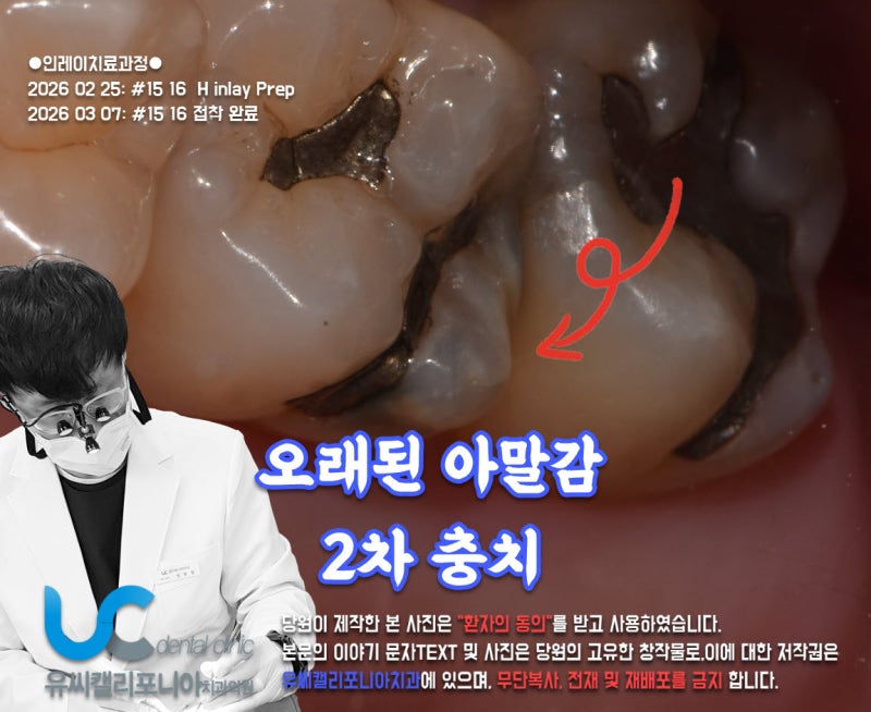 레진인레이 깨질까 봐 걱정된다면? 세라믹 알갱이로 강도 높인 하이브리드인레이!