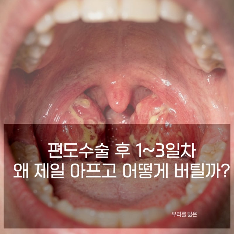 편도수술 후 1~3일차 통증이 제일 심한 이유 | 응급실 간호사가 알려주는 버티는 법