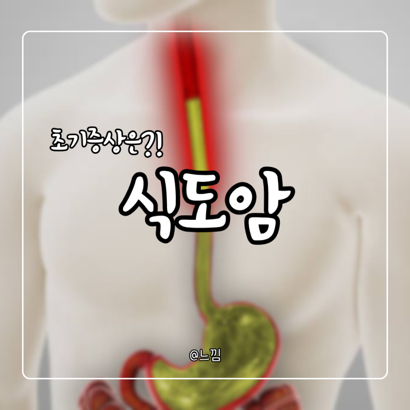 식도암 증상 원인 3기 4기 생존율 초기증상