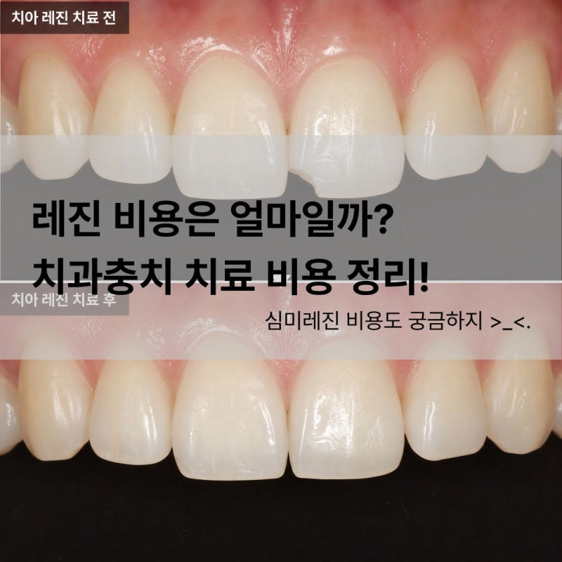 치과 레진 비용, 실제로 얼마일까?