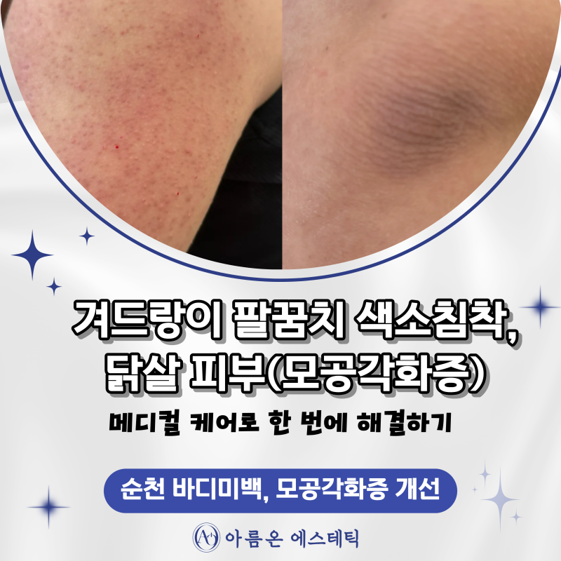 [순천 바디미백] 겨드랑이 팔꿈치 색소침착, 닭살 피부(모공각화증) 고민 메디컬 케어로 한 ....