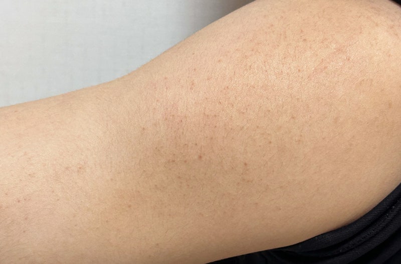 다리 모공각화증 원인 증상 피부에 오돌토돌 연고 바디로션 크림 후기