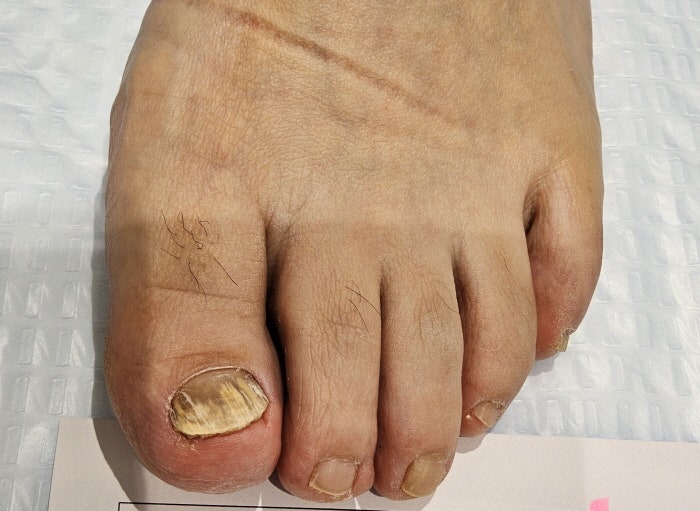 주안발톱무좀 단순 발냄새로 넘기면 안되는 질환!
