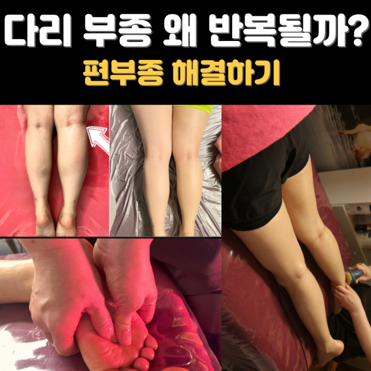  다리부종과 종아리 붓기, 허벅지와 다리가 살쪄 보이는 현상 천안하체관리