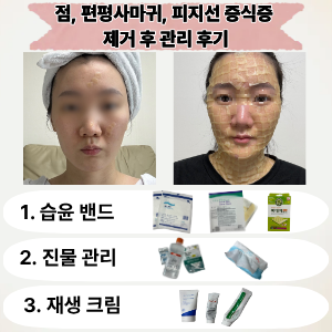 점, 편평사마귀, 피지선 증식증 레이저 제거 후 관리법