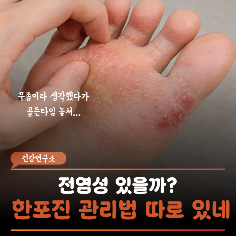 "무좀이 아닐 수도 있다고요?" 가렵고 진물 나는 발바닥 한포진 골든타임 놓치면 생기는 일