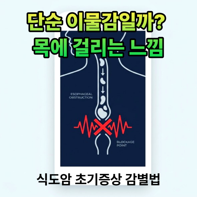 [식도암 증상] 목에 이물감 유발하는 초기 신호와 병기별 5년 생존율 및 최신 치료방법