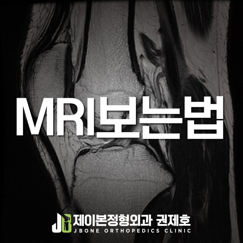 무릎 MRI 보는 법, 연골과 연골판 그리고 인대