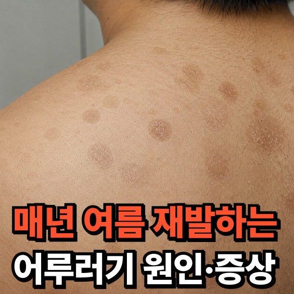 어루러기 원인·증상 매년 여름 재발한 피부 발진 관리법