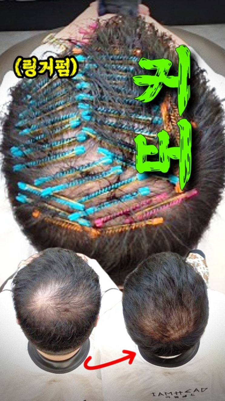  청주 남자 얇은머리 고민 해결! 수원 모류교정 링거펌으로 정수리 볼륨 되찾은 후기