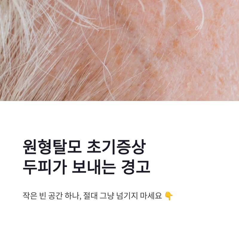 원형탈모 초기증상, 작은 빈 공간이 보내는 두피의 경고