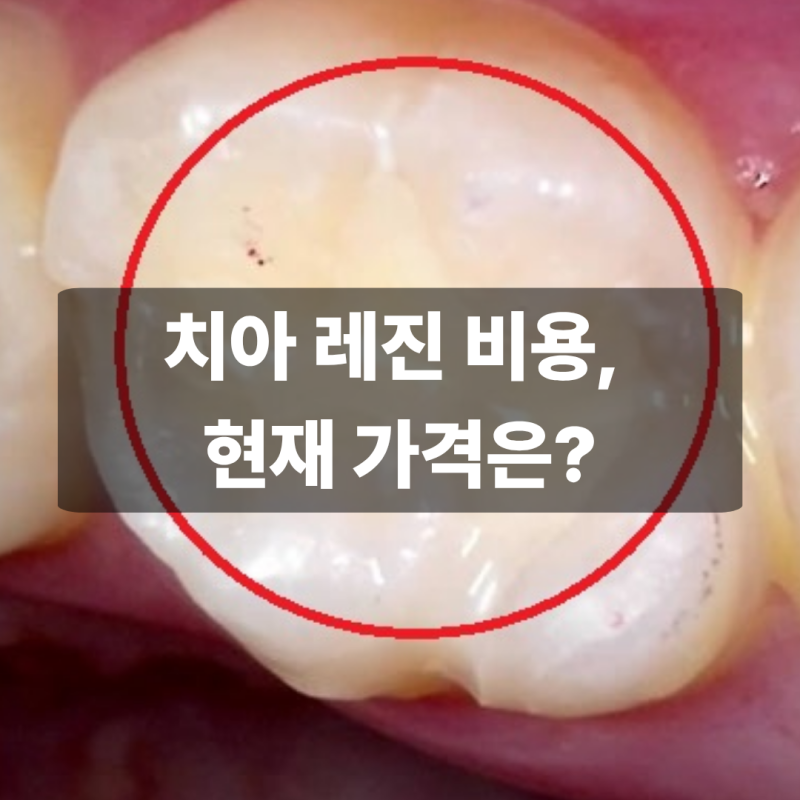 치아 레진 비용, 현재 가격은 얼마인가요?