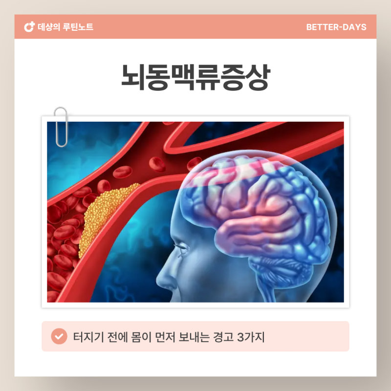 뇌동맥류증상 '이 신호' 3가지, 터지기 전에 몸이 먼저 경고합니다