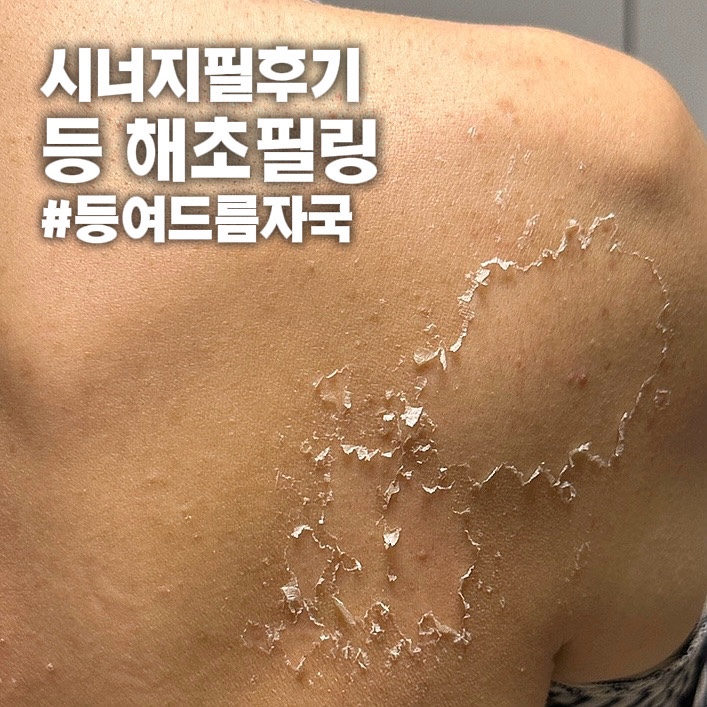  [내돈내산] 메디스코 시너지필 셀프 등 해초필링 솔직후기 (효과, 통증, 주의사항 총정리)