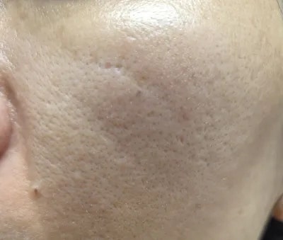 내돈내산 제오민 스킨보톡스 2주차 솔직 후기 : 리쥬란과 비교, 유지기간 가격대비 글쎄? (비....