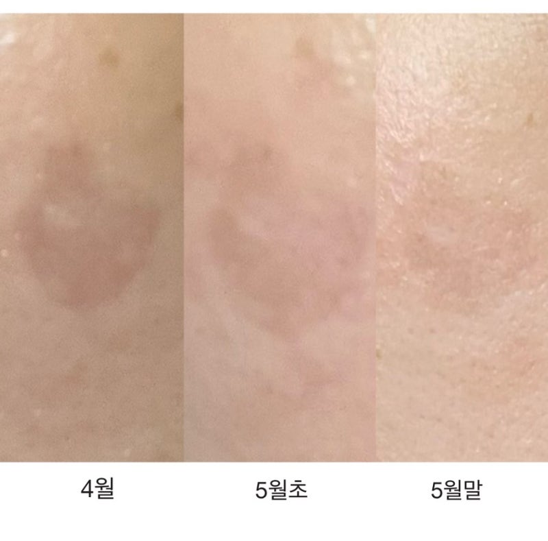 [더마팩토리] 레티날·트라넥삼산 사용기(3) | 레이저 없이 흑자제거 가능할까?