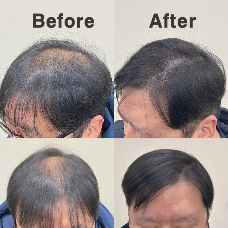  부평두피문신, 부작용이 생기는 진짜 원인과 예방법