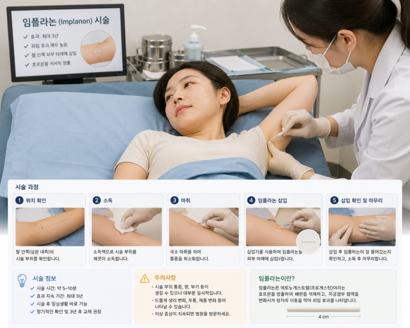 임플라논 가격 괜찮네 부작용까지 자세히 알려줄게