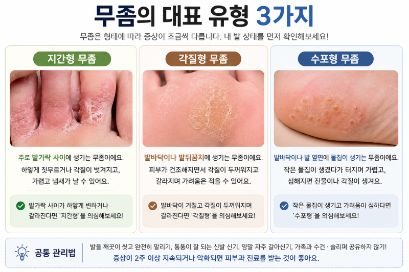 약국 무좀약 완벽 정리! 라미실 터비뉴 바르지오모두 엑소데릴 어떤 무좀약이 좋을까? (수포....