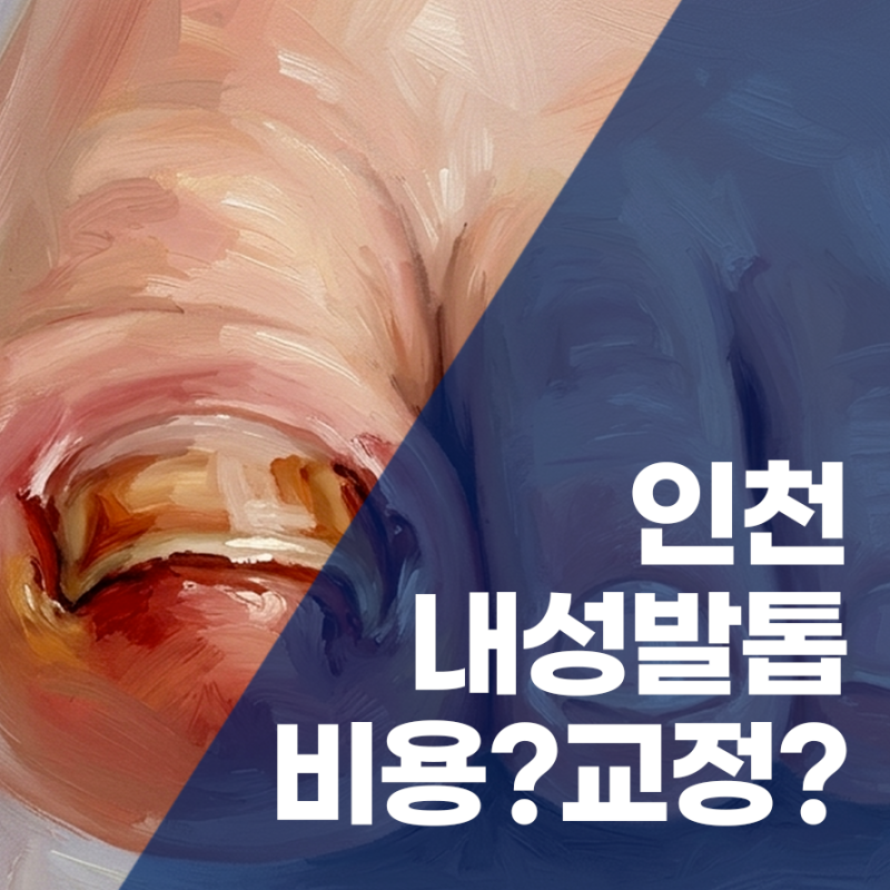 인천 내성발톱 병원 찾는다면? 치료비용부터 교정치료까지 설명드립니다