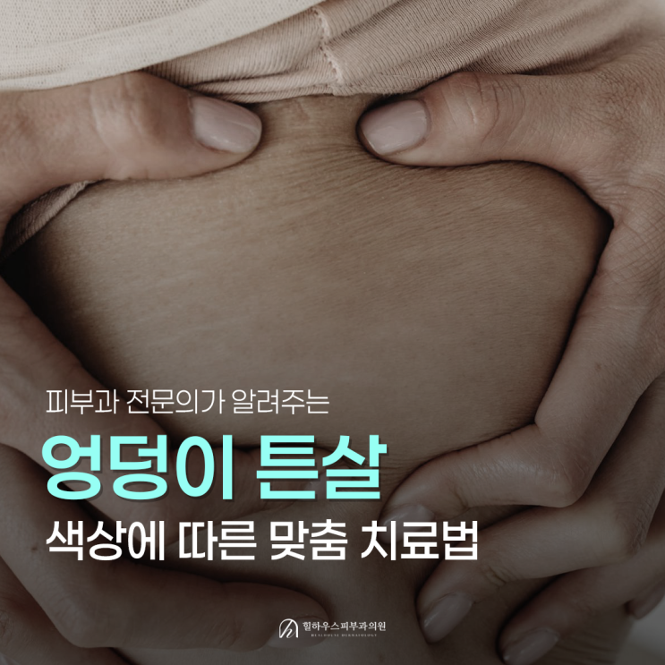  수원 엉덩이 튼살 피부과 원인, 치료 방법, 예방 방법