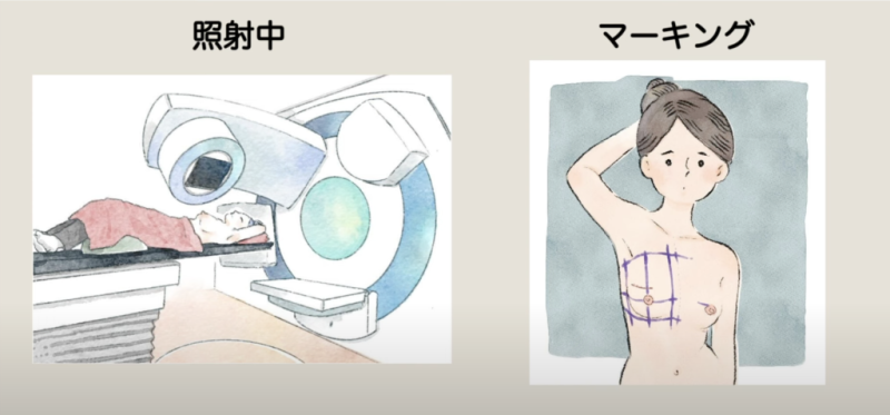 유방암 방사선치료 부작용 줄이는 방법