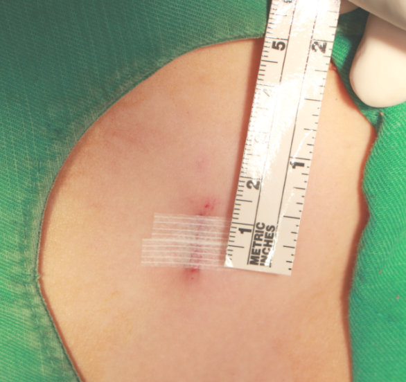 절개 탈장수술은 복부 전체를 여는 개복수술과 어떻게 다른가요? 최소침습 탈장수술 강리페....