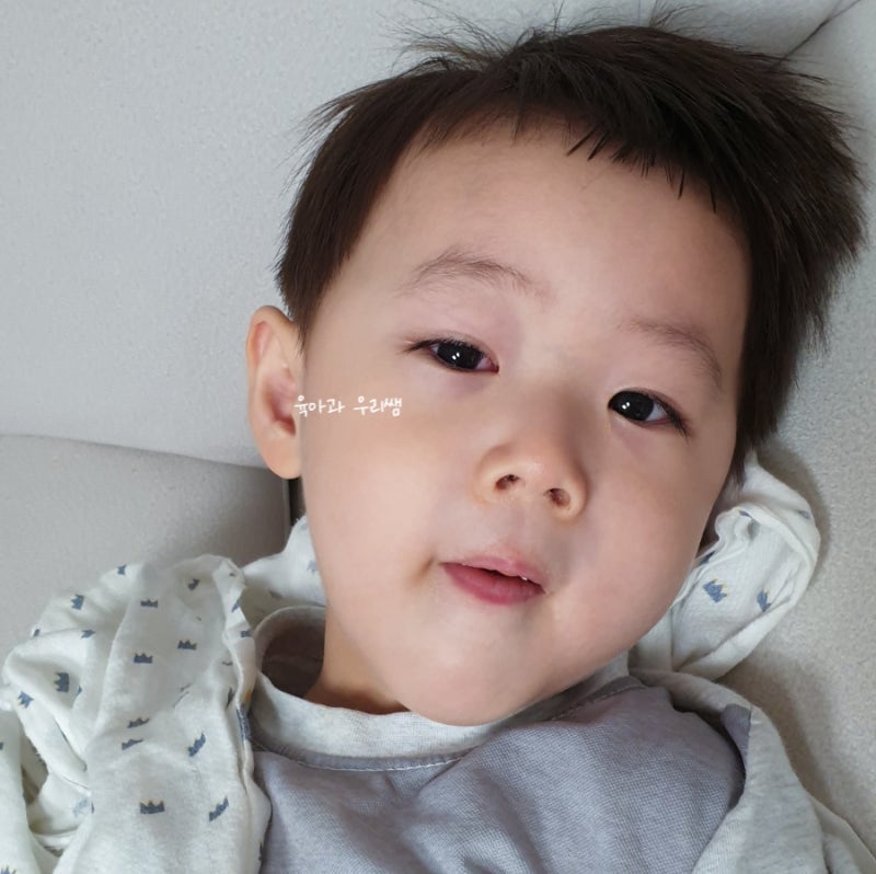 알레르기성 결막염 증상, 아기 알레르기 결막염 안약 넣는법