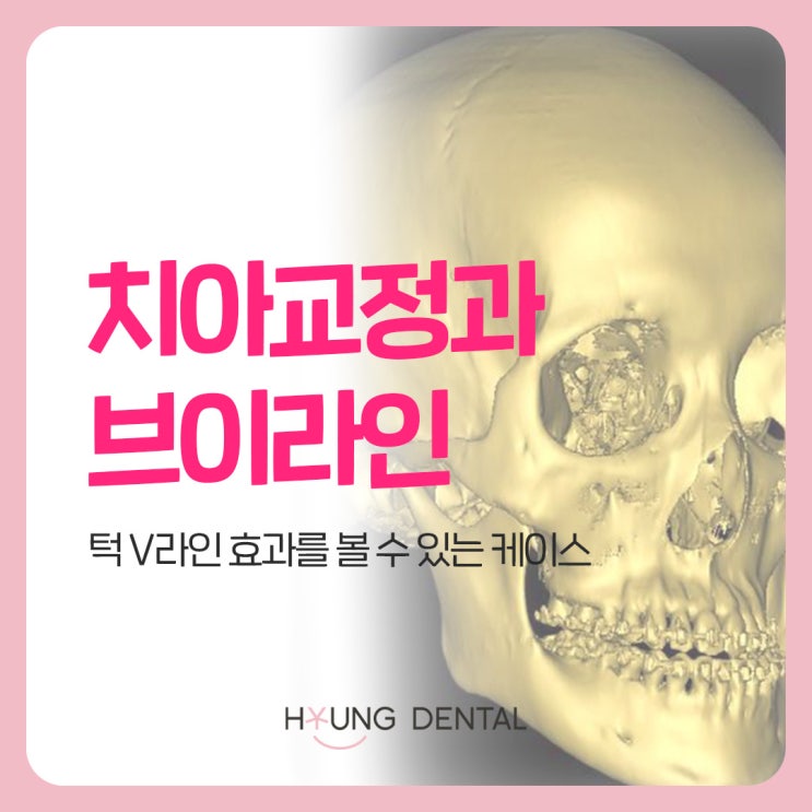  교정 후 브이라인이 된다? 수원 치과가 말하는 진실