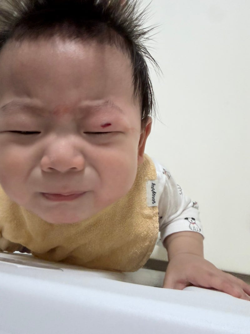 9개월 아기 눈두덩이 봉합수술 후기 (땡깡이 첫 훈장)
