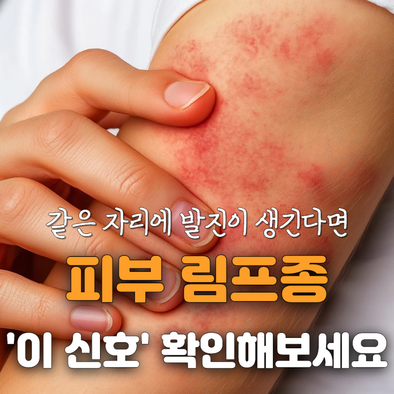 피부 T세포 림프종 초기 증상 5가지, 습진과 헷갈리는 신호