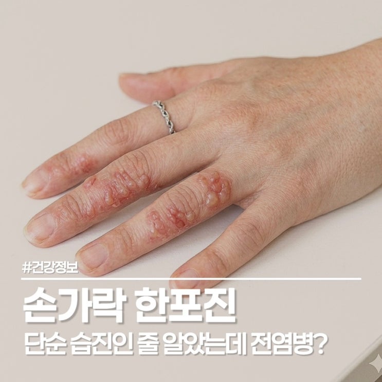  밤마다 가렵던 손가락 한포진 전염되나요?